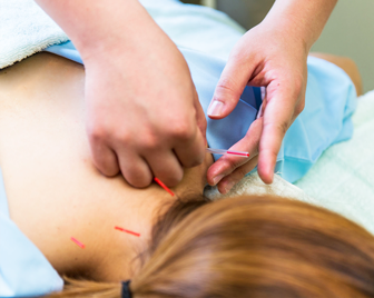 【上半身へのアプローチ】はり治療・灸治療の写真1