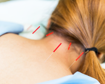 【上半身へのアプローチ】はり治療・灸治療の写真2